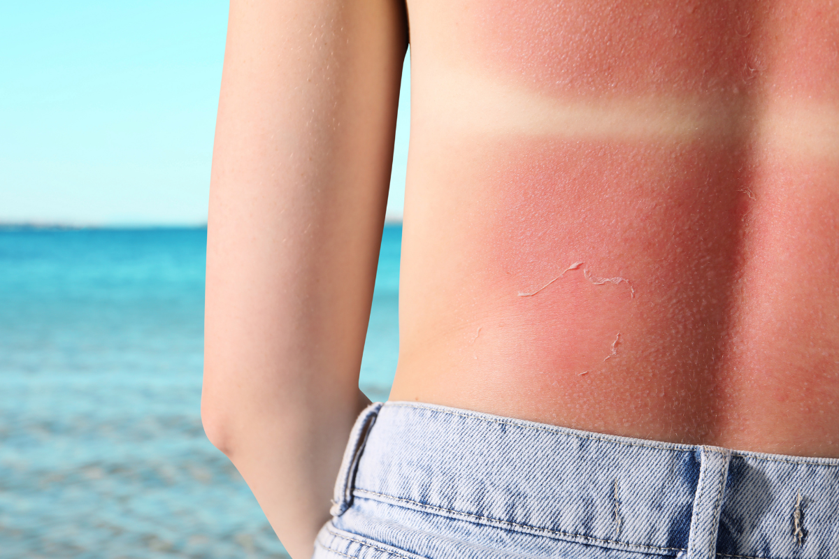 Aloë Vera als aftersun voor de gevoelige huid: werking en tips