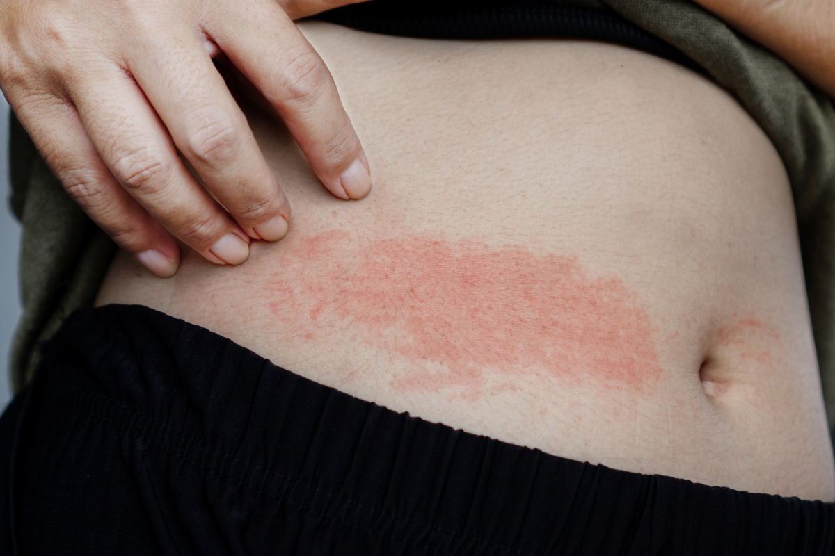 Aloë Vera voor droge en geïrriteerde huid: werking, voordelen en tips